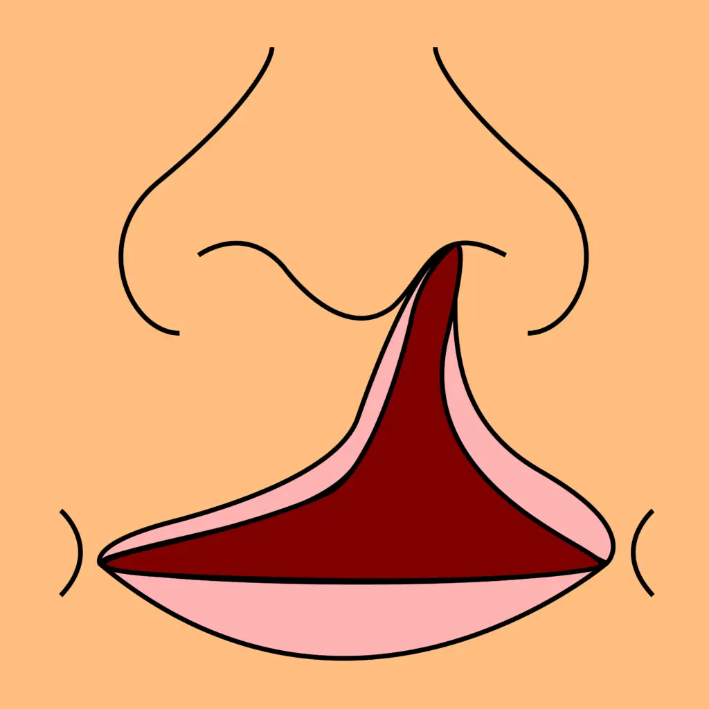 cleft lip unilateral complete (left side)