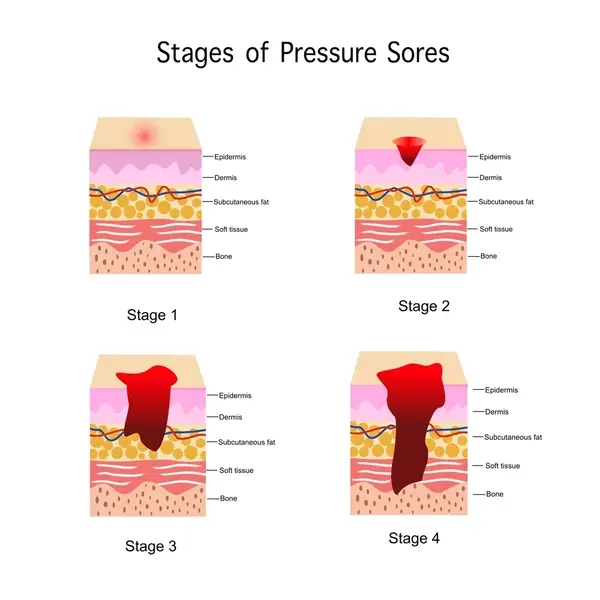 stage pressure soresinfographic design health 600nw 2260390075