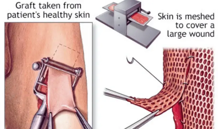 what happens during skin graft procedure 08 23